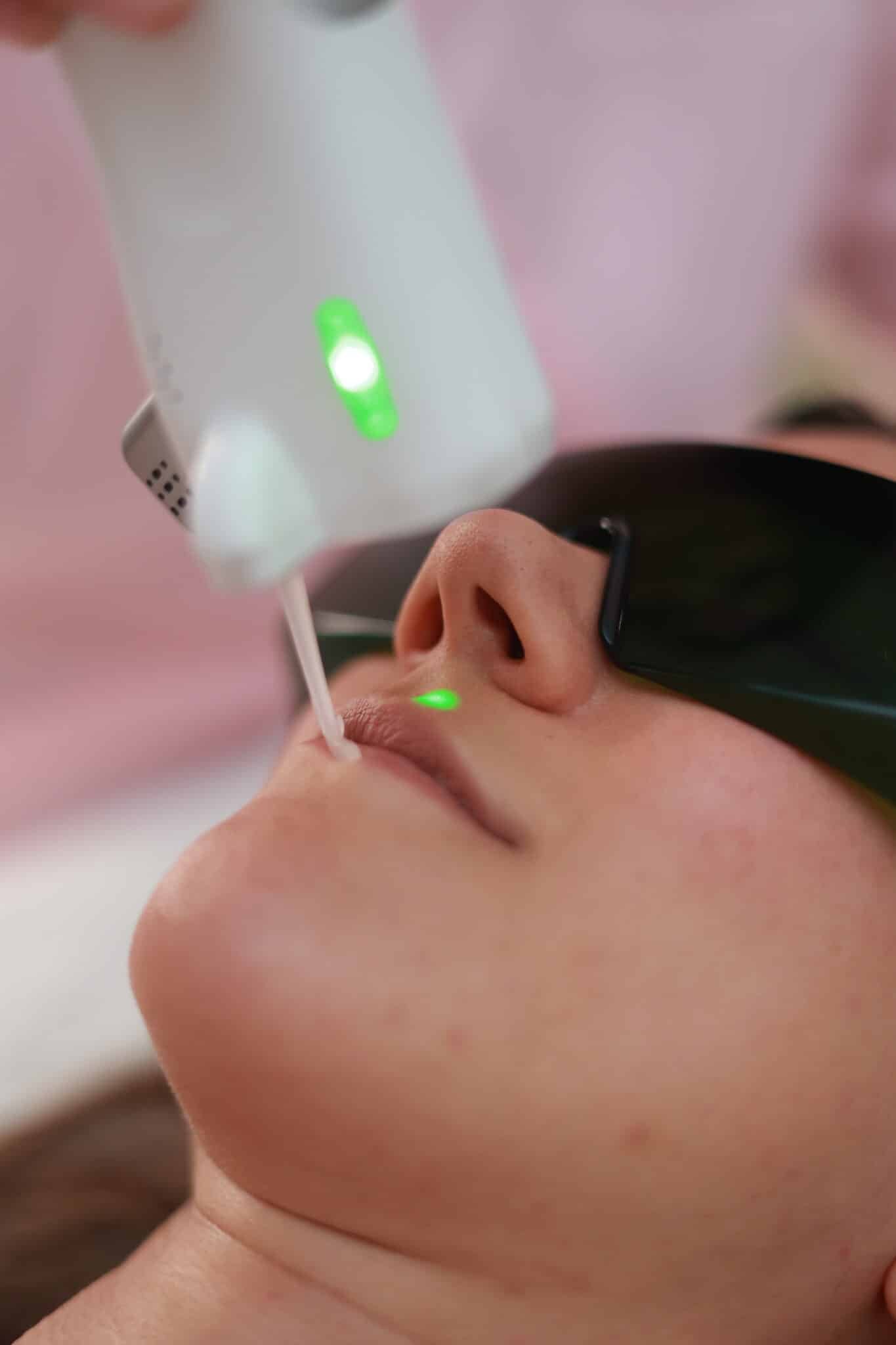 Epilation laser visage