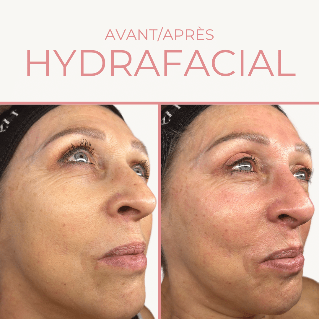 Hydrafacial femme Paris 16