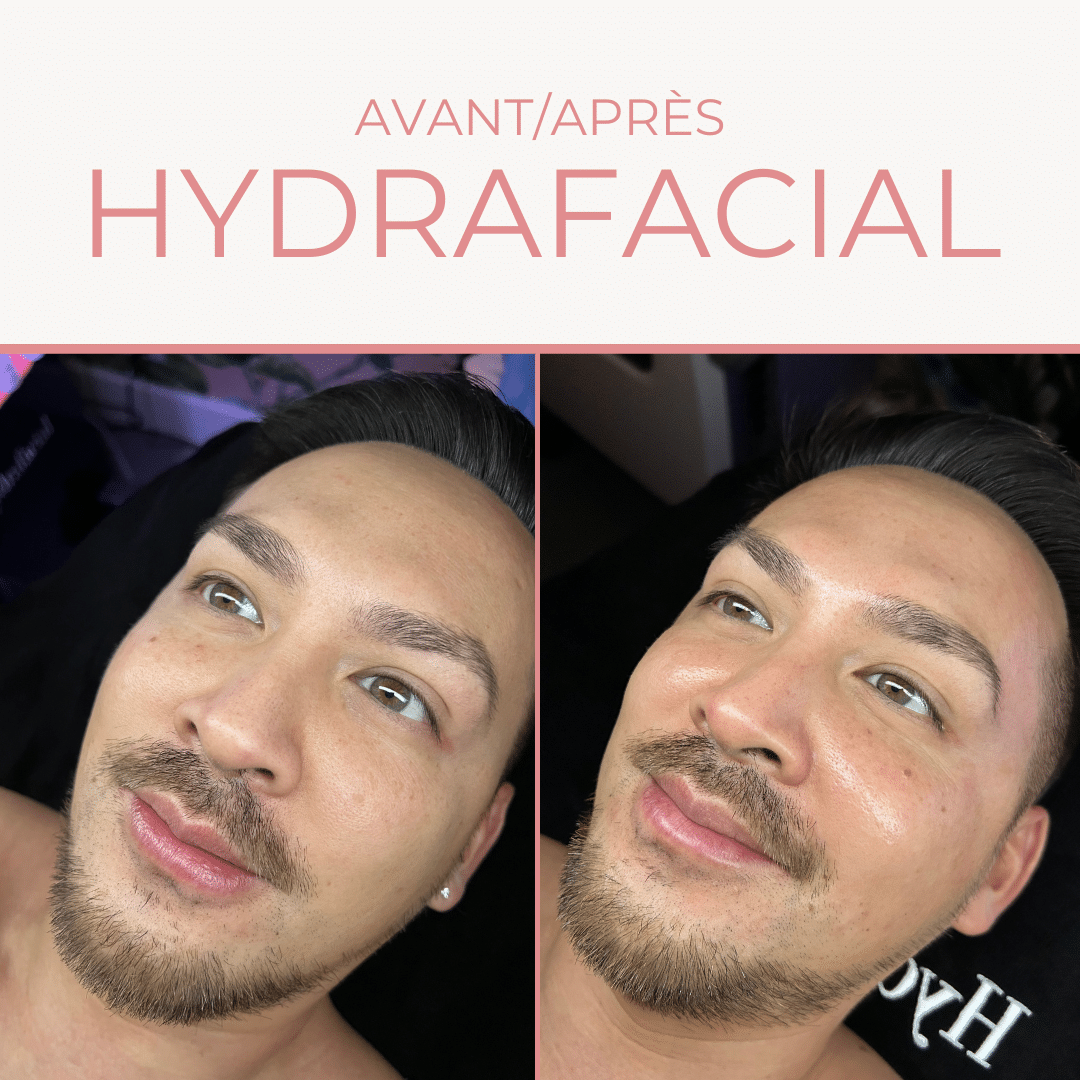 Hydrafacial homme Paris