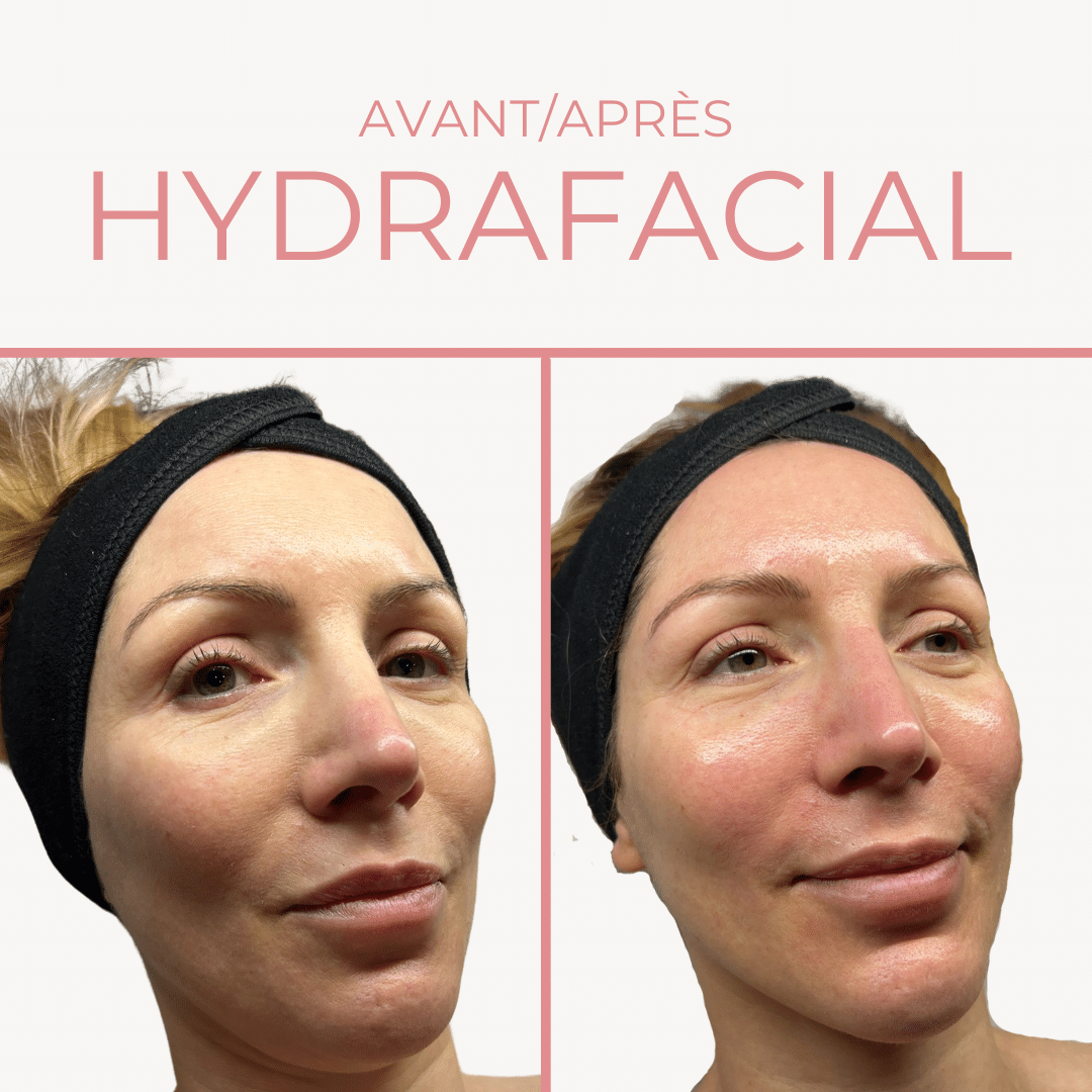 Hydrafacial jeune femme Paris
