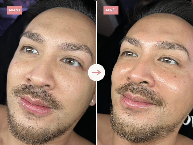 Hydrafacial avant apres